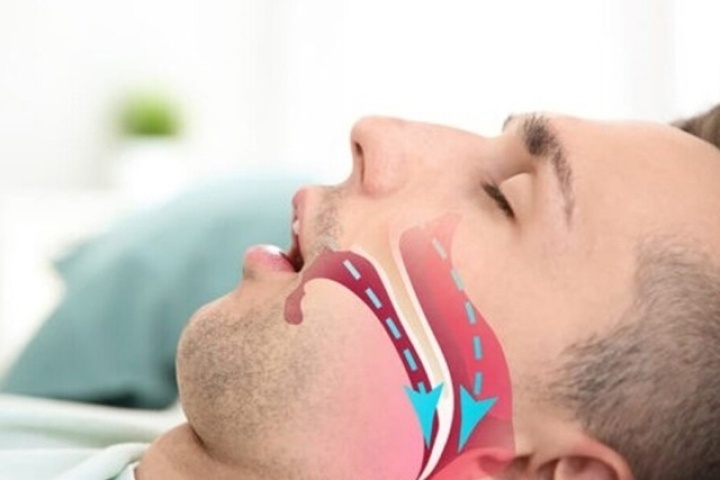 Ngáy to bị vợ giục đi khám, phát hiện căn bệnh có thể dẫn đến đột quỵ