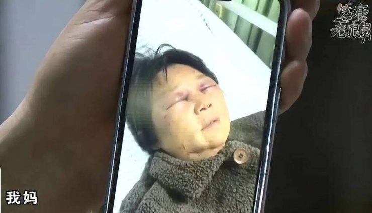 Bà Shen bị con dâu hành hung, gãy 4 xương sườn. Ảnh: Sohu