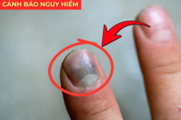 Tin tức sức khỏe - 5 dấu hiệu báo động phổi đang "xuống cấp": Nhiều người hối hận vì biết quá muộn!