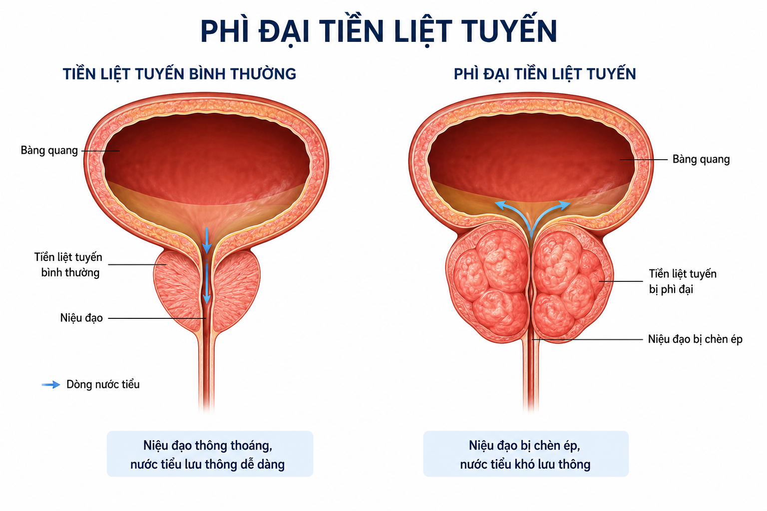 Đêm dậy đi tiểu, tiểu ngắt quãng: Quý ông sau 40 tuổi đừng vội đổ cho “tuổi già” - 1