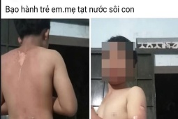 Công an vào cuộc vụ bé trai ở Đắk Lắk nghi bị mẹ tạt nước sôi