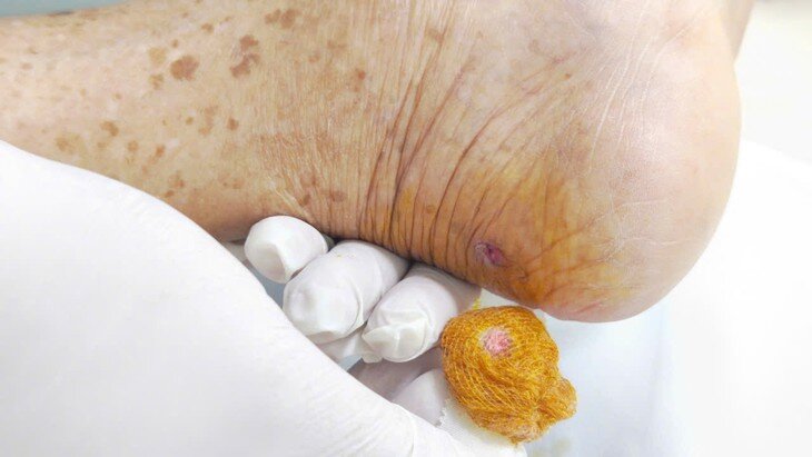 Hình ảnh tổn thương bàn tay trái (do ngã xe) và do bị gà mổ (phải) ở bệnh nhân. Ảnh: BVCC