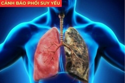 Tin tức sức khỏe - Đàm đặc mỗi sáng, ho mãi không dứt: Sai lầm nghiêm trọng khiến phổi ngày càng yếu