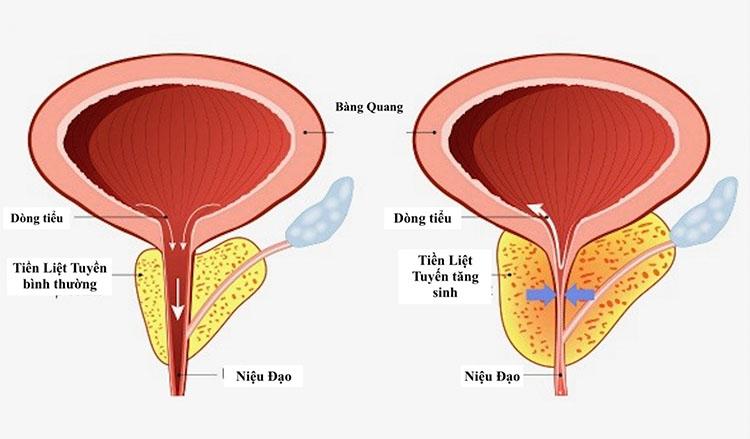 Có 1 trong 3 dấu hiệu này, quý ông nên kiểm tra tuyến tiền liệt càng sớm càng tốt! - 4