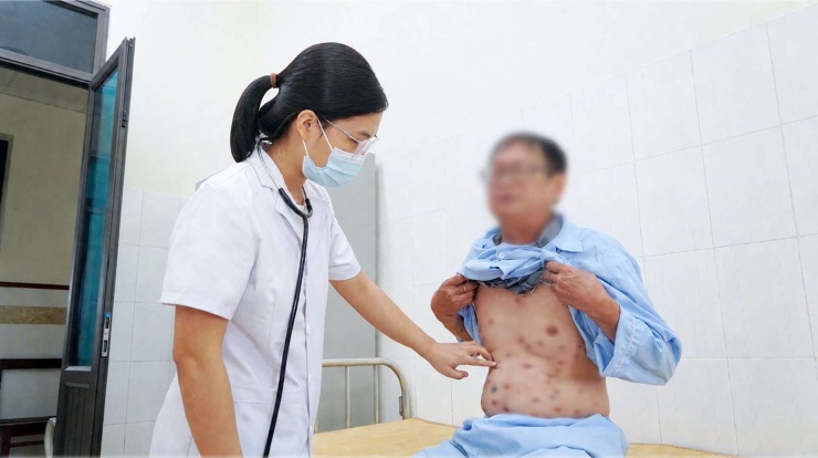 Người bệnh xuất hiện nhiều mụn nước, các mụn nước. Ảnh TTCC