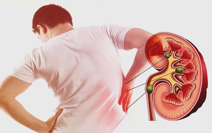 Suy thận thường tiến triển âm thầm nên nhiều người chỉ phát hiện khi bệnh đã nặng