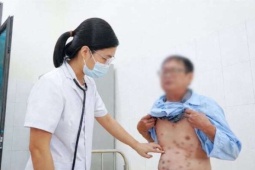 Ngứa điên tưởng viêm da, nào ngờ bệnh mãn tính nguy hiểm