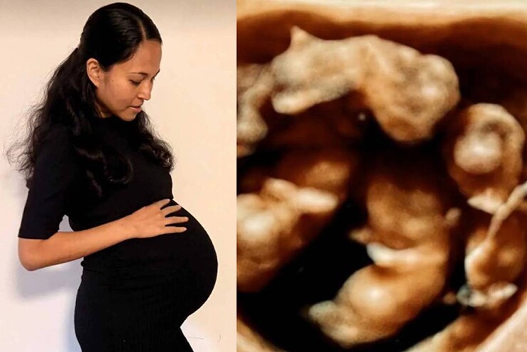 Ca sinh tư cùng trứng thụ thai tự nhiên, trong 15 triệu ca mới có một