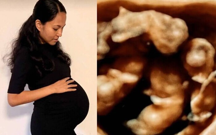 Ca sinh tư cùng trứng thụ thai tự nhiên, trong 15 triệu ca mới có một