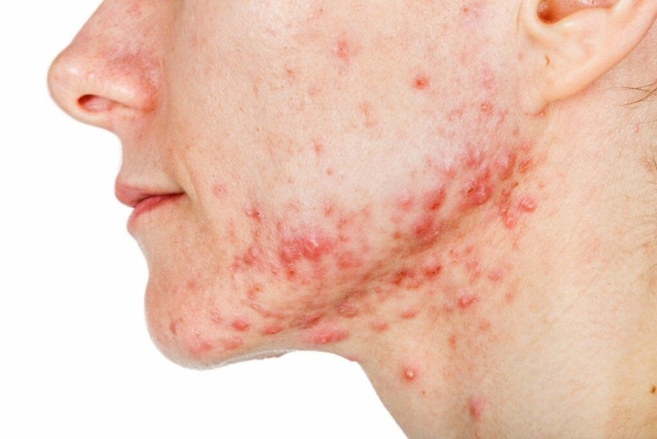Trước kỳ kinh, sự thay đổi nội tiết khiến tuyến bã nhờn hoạt động mạnh hơn, làm tăng nguy cơ nổi mụn, đặc biệt ở vùng cằm và quai hàm. Ảnh: CFD