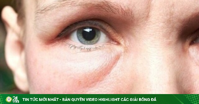 Mặt sưng sau khi ngủ dậy: Dấu hiệu bình thường hay cảnh báo sức khỏe?