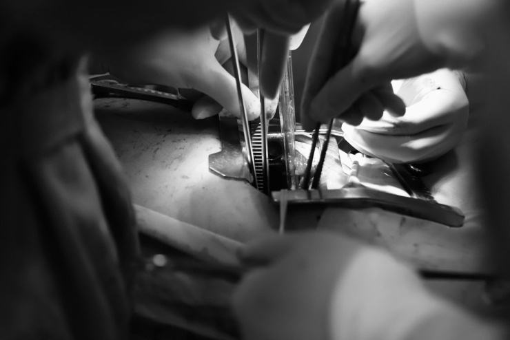 Thay vì phải cắt bỏ toàn bộ lá phổi, phẫu thuật Sleeve chỉ cắt bỏ phần phổi chứa khối u cùng đoạn phế quản bị xâm lấn, sau đó tái tạo đường thở bằng cách nối phần phế quản còn lành. (ảnh: BVCC)
