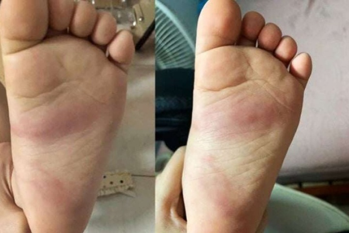 Hưng Yên: Xác minh phản ánh trẻ 3 tuổi bị bầm tím chân sau khi ở trường mầm non về