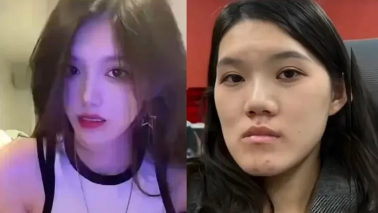 Xiaoyu trước và sau khi thực hiện phẫu thuật chỉnh hàm.