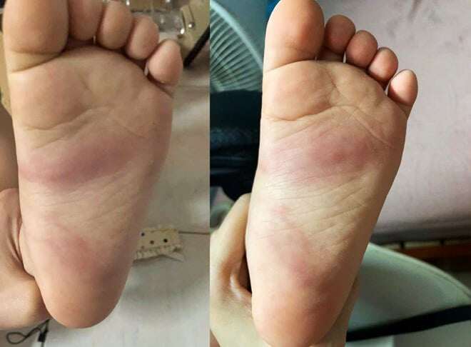 Lòng bàn chân cháu bé hằn vết bầm tím nghi do bị giáo viên bạo hành. (Ảnh: Gia đình cung cấp)