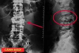 Tin tức sức khỏe - 5 thói quen tàn phá xương khớp cực nhanh, nên bỏ càng sớm càng tốt.