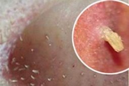 Tin tức sức khỏe - Đàn ông con trai bị mụn: Chấm dung dịch này mỗi tối là sạch, không cần đi Spa với bôi kem như con gái