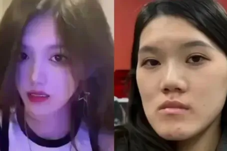 Người mẫu biến dạng mặt sau ca chỉnh hàm sai 13 milimet