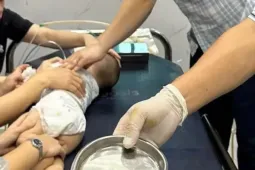Cứu thành công bé trai hơn 1 tuổi nguy kịch vì hóc hạt chôm chôm