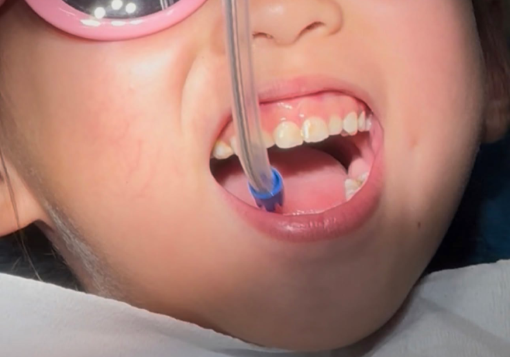 Bé được bác sĩ trám răng không cần gây mê. Ảnh: GĐCC.