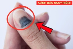 Tin tức sức khỏe - 5 dấu hiệu báo động phổi đang "xuống cấp" rất nhanh: Nhiều người hối hận vì biết quá muộn!
