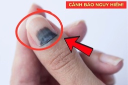 Tin tức sức khỏe - Loại rau dại mọc đầy đường nay được xem như “thuốc quý” cho đường tiết niệu, giúp đi tiểu thông thoáng, dễ dàng