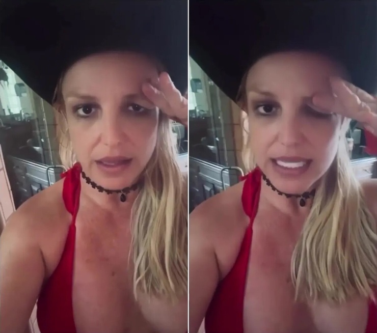 Britney minh họa mí mắt bị sụp do tiêm botox.