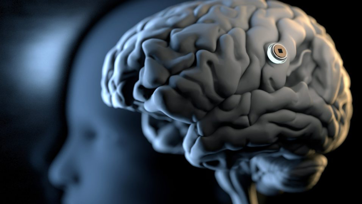 Giao diện não-máy tính (Brain-Computer Interface) là công nghệ kết nối trực tiếp hoạt động của não với máy tính hoặc các thiết bị điện tử, cho phép người sử dụng điều khiển thiết bị bằng tín hiệu thần kinh và suy nghĩ thay vì thao tác bằng tay. Ảnh: Neuralink 