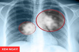 Tin tức sức khỏe - Tư thế ngủ tốt nhất cho phổi giúp giảm đàm, ho, thở dễ hơn: Rất nhiều người đang làm sai!