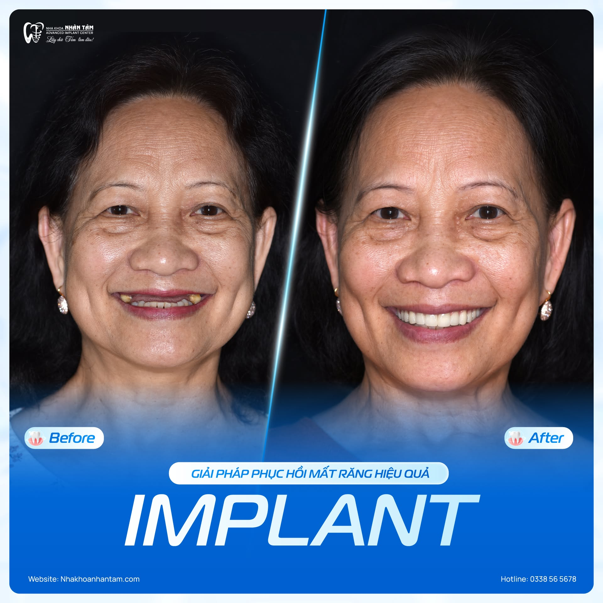 Khách hàng sau khi hoàn tất phục hình Implant tại Nha khoa Nhân Tâm