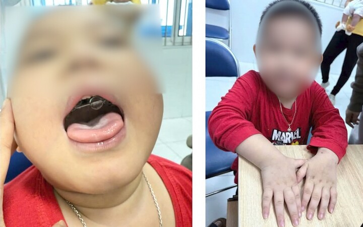 Bệnh nhi thăm khám sau thời gian điều trị. (Ảnh: BVCC)