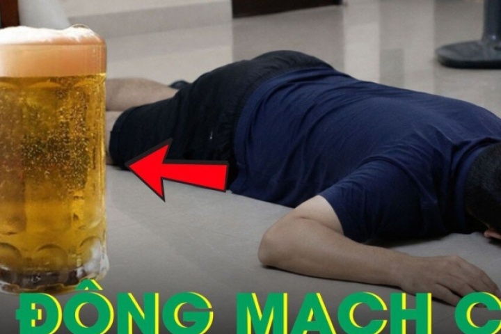 Người đàn ông 36 tuổi vỡ động mạch chủ sau khi uống bia theo cách này