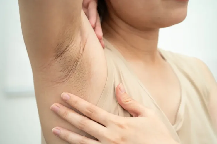 Cạo lông, nhổ lông lâu ngày cũng dễ khiến vùng da dưới cánh tay sần sùi, kém mịn màng.