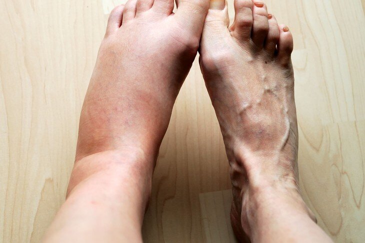 Phù chân là một trong những biểu hiện của bệnh thận. Ảnh: BV