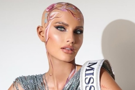 Hoa hậu Mỹ gây xúc động khi chia sẻ về chứng rụng tóc tại Miss World