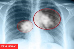 Tin tức sức khỏe - Tư thế ngủ tốt nhất cho phổi giúp giảm đàm, ho, thở dễ hơn: Rất nhiều người đang làm sai!