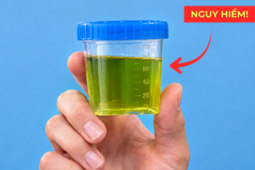 Tin tức sức khỏe - Nước tiểu buổi sáng có màu này, coi chừng cơ thể đang phát tín hiệu “cầu cứu”!