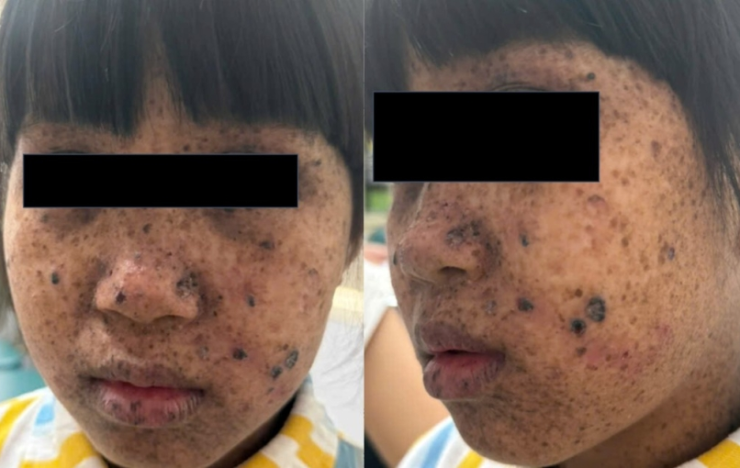 Hình ảnh tổn thương da của người bệnh trước mặt và vùng sau lưng sát cổ. Ảnh BVCC