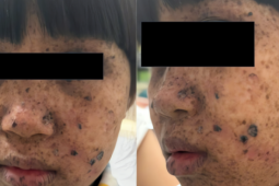 Bé gái 8 tuổi có làn da "phong sương", mặt phủ kín tàn nhang, đồi mồi