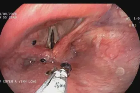 Đàn kiến chui vào thanh quản người đàn ông