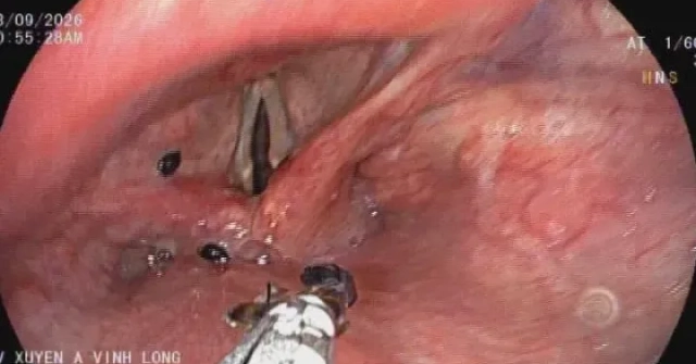Đàn kiến chui vào thanh quản người đàn ông