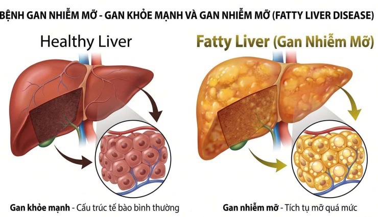 Gan nhiễm mỡ có thể tiến triển từ nhẹ đến viêm gan, xơ gan, thậm chí ung thư gan. Ảnh tạo từ Gemini