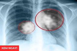 Tin tức sức khỏe - Tư thế ngủ tốt nhất cho phổi giúp giảm đàm, ho, thở dễ hơn: Rất nhiều người đang làm sai!