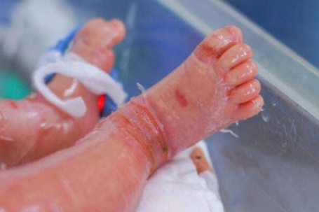 Cứu sống bé sơ sinh mắc bệnh vảy cá hiếm gặp, bị lộn mi mắt