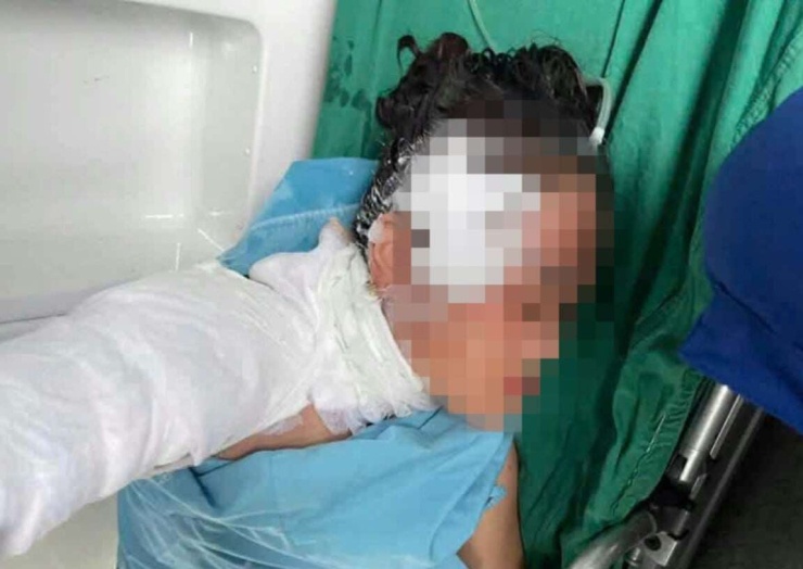 Nạn nhân bị sét đánh trúng được đưa đến bệnh viện với vết thương ở đầu. Vùng cổ và cánh tay bị bỏng do tia sét. Ảnh: MXH
