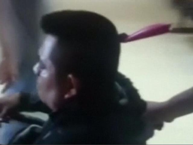 Dao cắm xuyên đầu, ung dung vào viện nói chuyện với bác sĩ