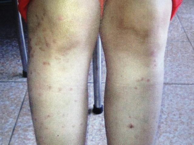 Sức khỏe đời sống - Tưởng nổi mụn lạ, cô gái khổ vì "bệnh siêu giả dạng"