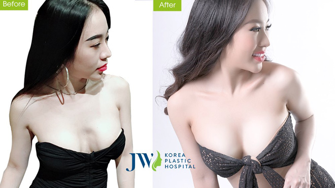 DJ Nhung Babie cực nóng bỏng và sexy sau nâng ngực - 5