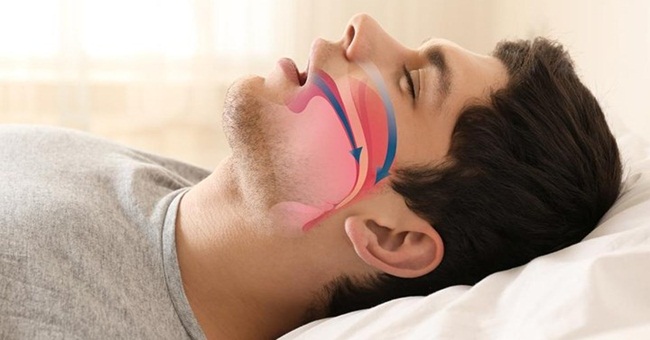 Nếu chảy nước dãi khi ngủ, bạn đang gặp những vấn đề sức khỏe này - 1