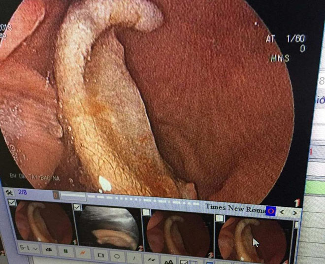 Nội soi lấy phần tai bị cắn đứt trong bụng một học sinh - 1